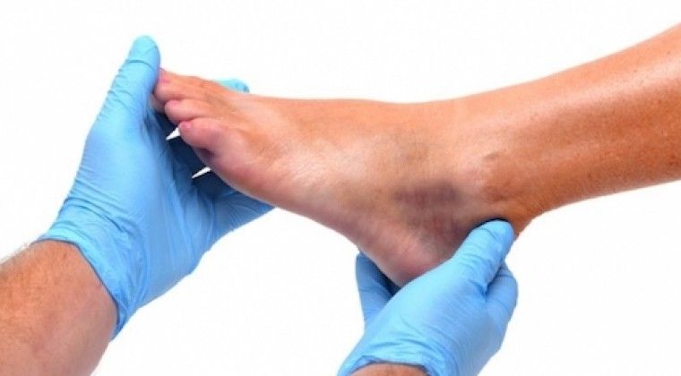 Causas y tipos de amputación en el pie