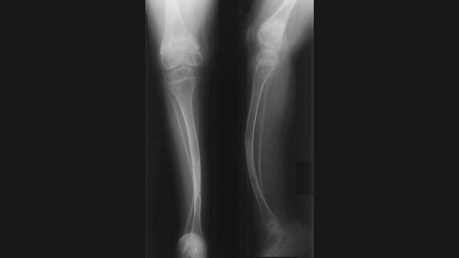 ¿Qué es la osteogénesis imperfecta?