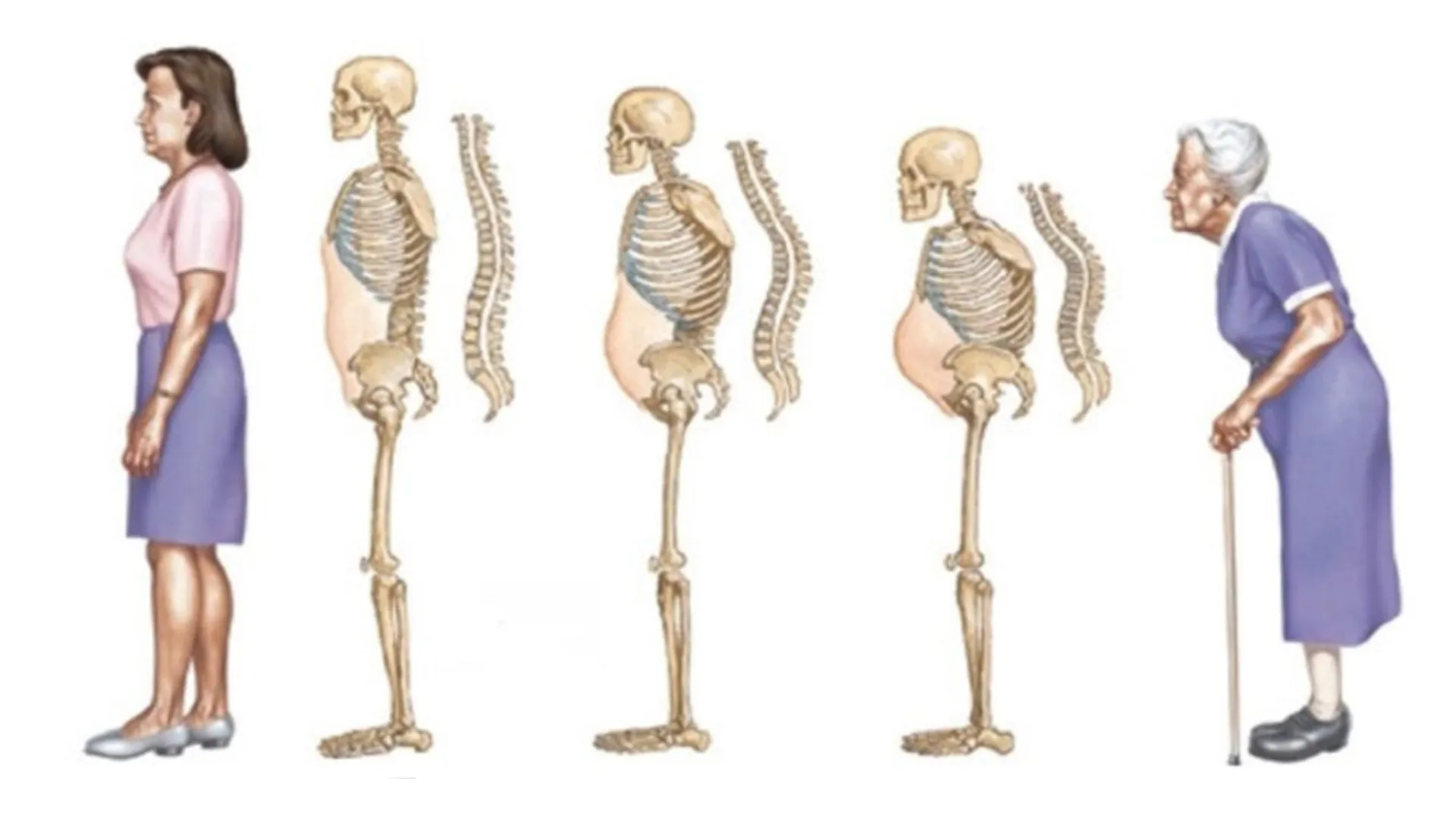 Osteoporosis y el Riesgo de Fracturas