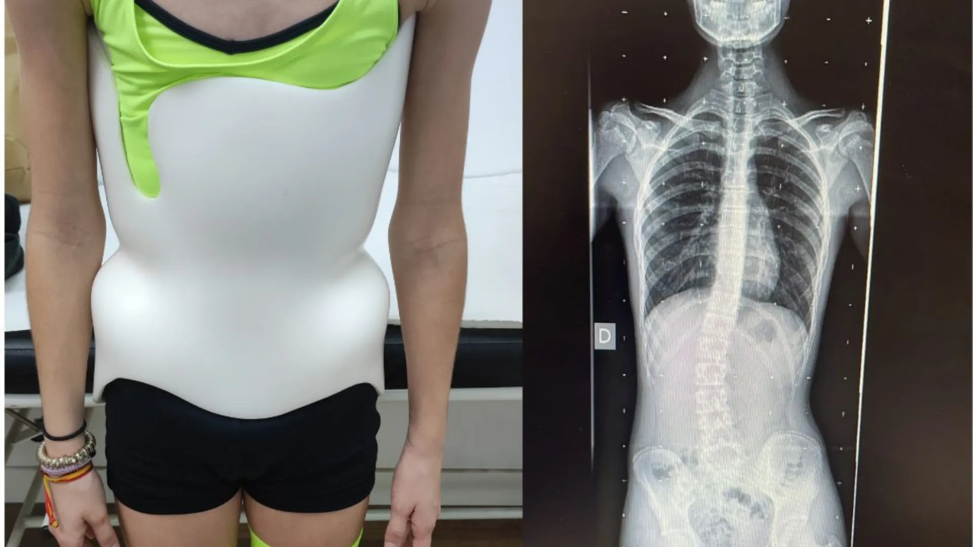 La Importancia del Uso del Corsé Corrector para la Escoliosis