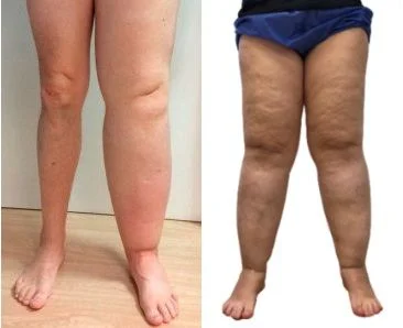 Diferencias entre lipedema y linfedema