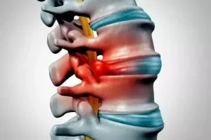 Hernia discal y tratamiento con ortesis lumbar