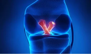 Lesiones en ligamentos cruzados