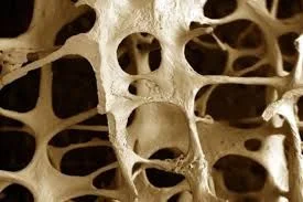 Osteoporosis