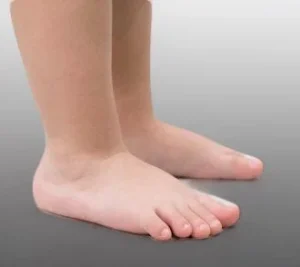 Pie plano valgo infantil