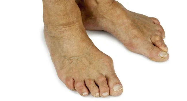 Plantillas a medida para el Hallux Valgus y los Dedos en Garra: ¿Por qué son importantes?