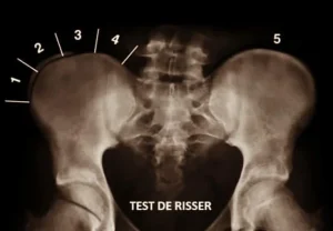 ¿Qué es el índice de Risser?