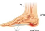 Fascitis plantar: ¿Por qué el dolor de talón no desaparece sin plantillas a medida?